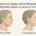 Diferencias reales entre lifting SMAS y lifting deep plane en pacientes complejos